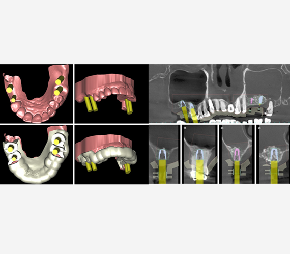 Implant Surgery