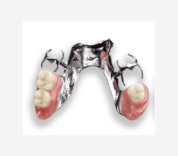 Metal Partial Dentures (Chrome Cobalt)